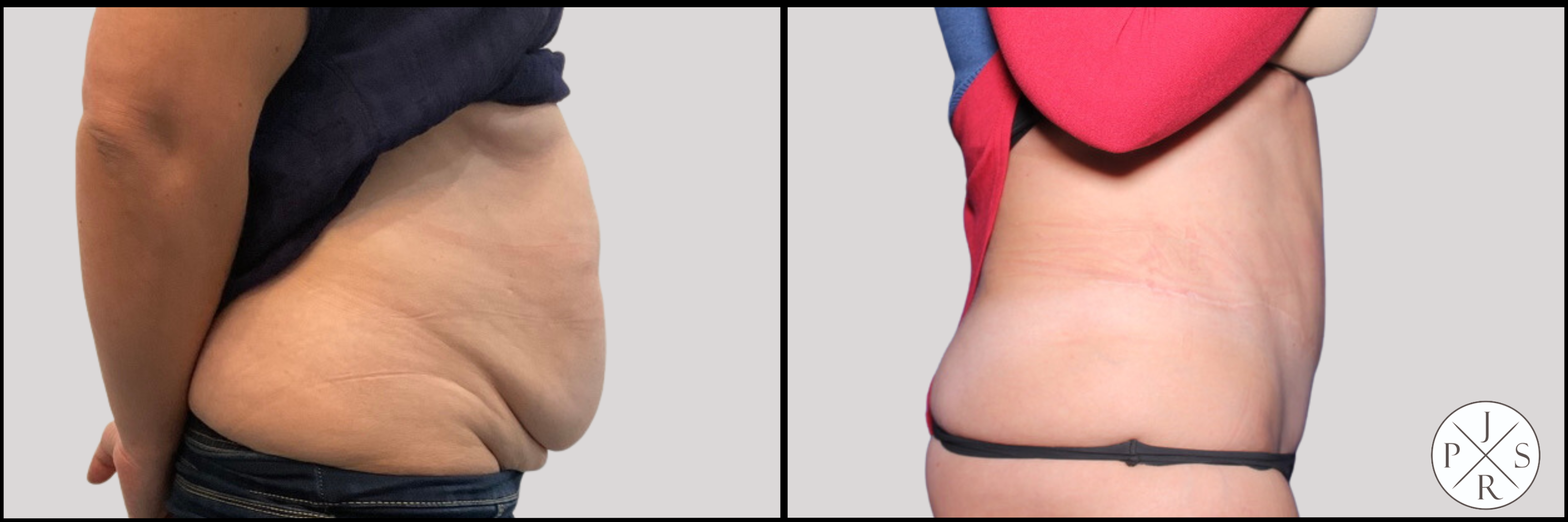 Abdominoplasty Before & After Image